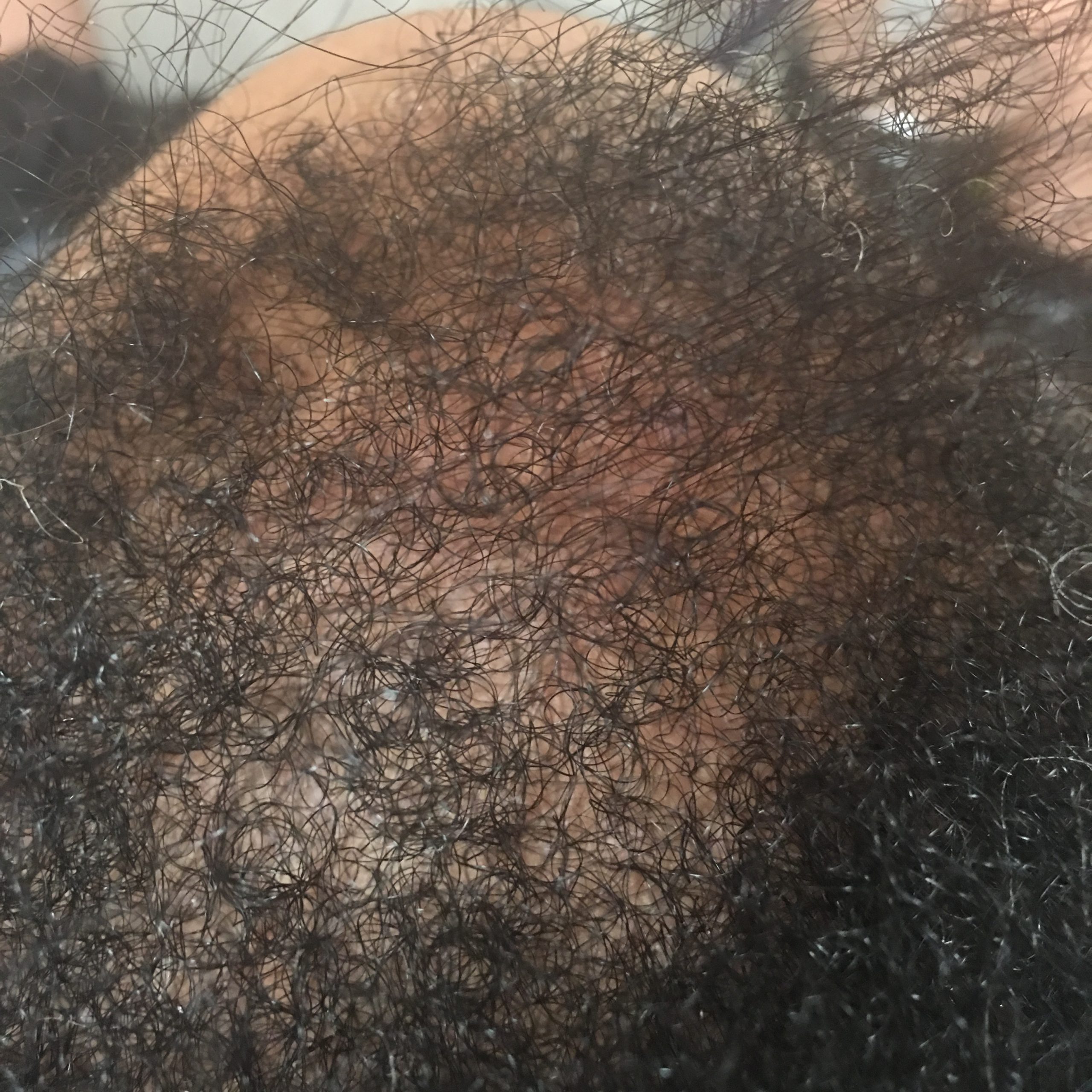 Pattern Hair Loss After
